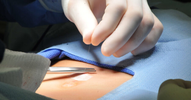 Over One Million Hernia Repairs are Performed in the U.S. Each Year